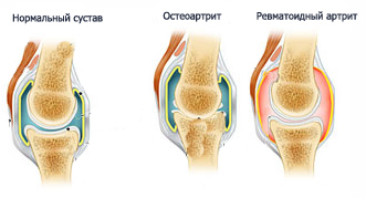 Отличия внешнего вида нормального сустава, сустава при остеоартрите и при ревматоидном артрите