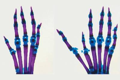 Чтобы понять, почему появляются лишние пальцы, ученые взялись за энхансеры