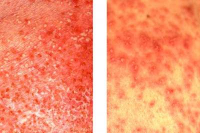 JAAD: Новый метод может помочь дифференцировать два кожных заболевания
