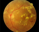 Новое в профилактике и лечении ишемизированной ретинопатии
