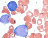 Ученые выявили маркер рака крови
