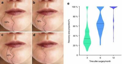Ученые сообщают о возможности восстановления чувствительности нижней губы после хирургической операции