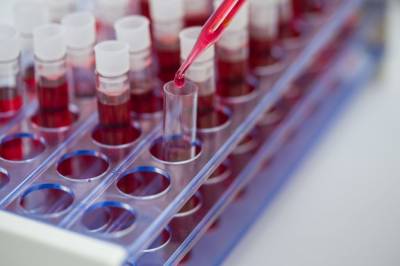 Ученые успешно определили повреждение ДНК в крови пациентов с Паркинсоном