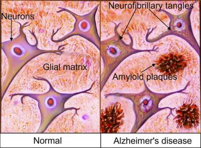 FDA одобрило применение моноклональных антител для лечения болезни Альцгеймера