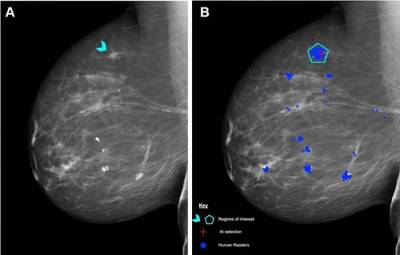 Radiology: Скрининг на рак молочной железы в будущем могут доверить ИИ