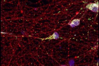 Neuron: Найден новый механизм развития синдрома хрупкой Х-хромосомы