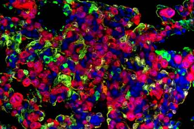 «Память» клеток рака легкого подсказала новую стратегию для улучшения лечения